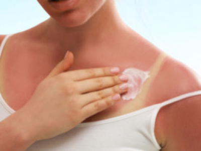 Apaiser un coup de soleil : huiles essentielles et conseils naturels